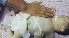 新生女婴如同“雪娃娃”“自动输血”给了妈妈